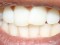 teeth-fog