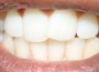 teeth-fog